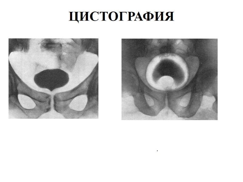 ЦИСТОГРАФИЯ Рис. 1. Дно мочевого пузыря приподнято   Рис. 2. Цистограмма по Kneise